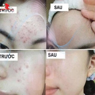 Gel giảm mụn ẩn, giảm thâm Megaduo Gel 15g, Megaduo Chính Hãng Cho Da Mụn, Thâm Mụn