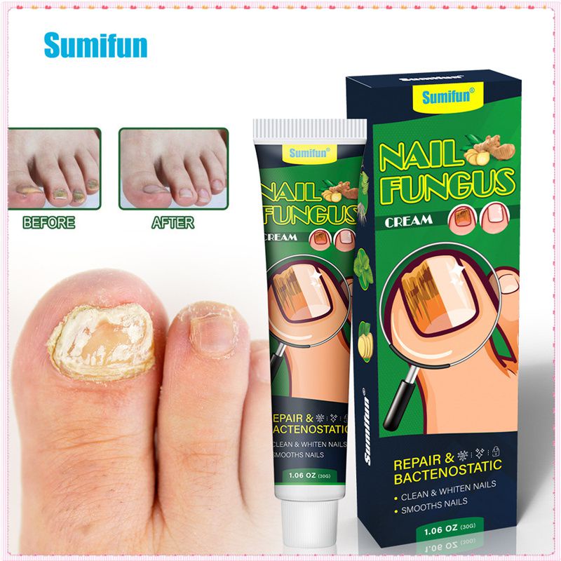 Sumifun Nail Fungus Cream Repair Onychomycosis Reduce Nail Fungal