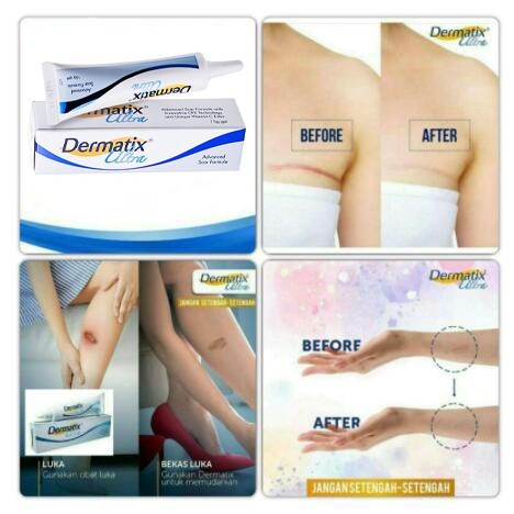 Ảnh Dermatix gel Hỗ trợ giảm sẹo 100% Chính Hãng 15g 4
