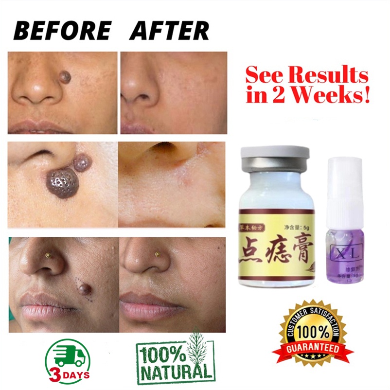Ảnh Kem tẩy nốt ruồi dạng đặc EELHOE Apgar loại bỏ da chết hỗ trợ giảm mụn cóc hiệu quả mạnh 3
