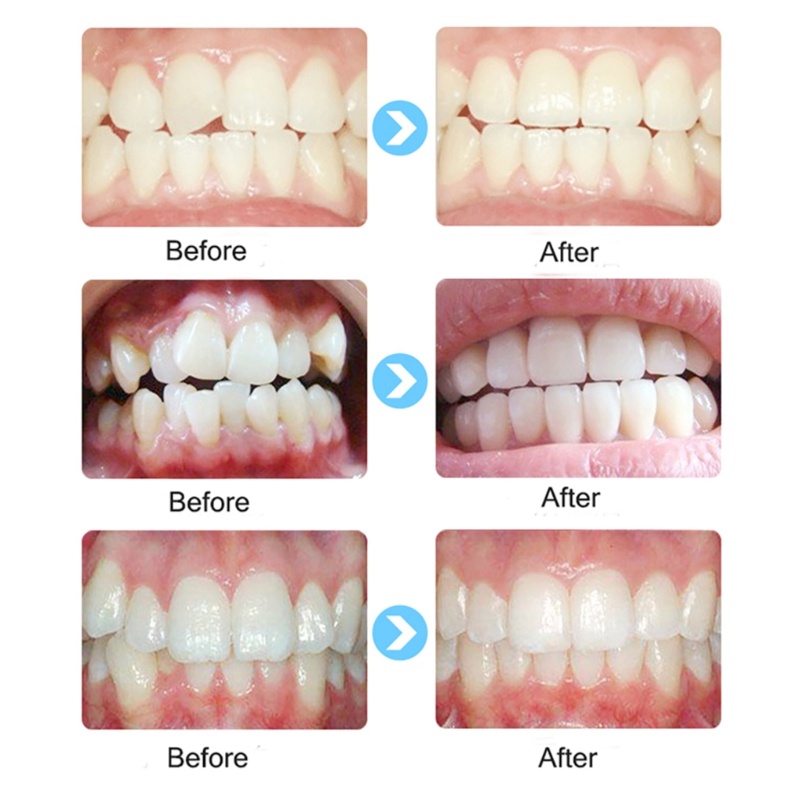 Richh teeth trainer cho trẻ em trẻ em thiết bị chỉnh nha răng căn chỉnh nha nha khoa nẹp miệng pha soft replacem