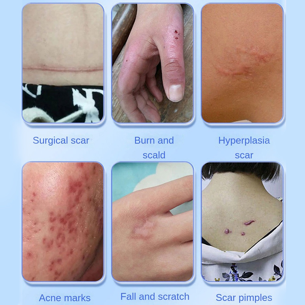 Ảnh Kem Hỗ trợ giảm sẹo / Vết Bỏng Hiệu Quả 4
