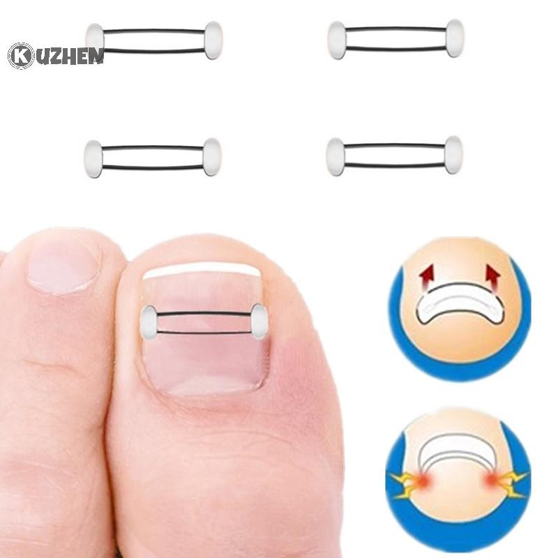 KUZHEN Dụng cụ chỉnh sửa móng mọc ngược chân, phục hồi, kẹp thẳng, nẹp điều trị, HOT