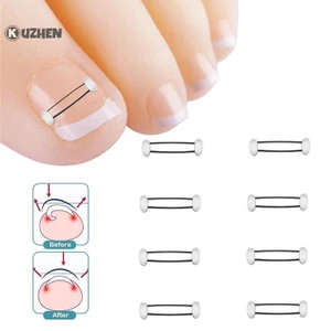 KUZHEN Dụng cụ chỉnh sửa móng mọc ngược chân, phục hồi, kẹp thẳng, nẹp điều trị, HOT