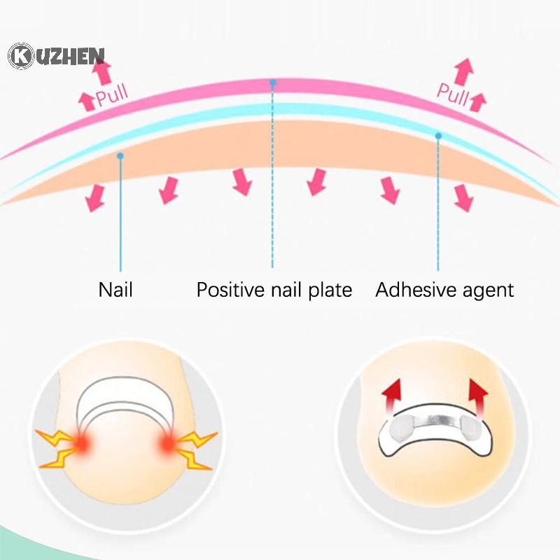 KUZHEN Công cụ chỉnh sửa móng mọc ngược, phục hồi móng, nhúng ngón chân, điều trị móng mọc ngược HOT Chăm sóc bàn chân
