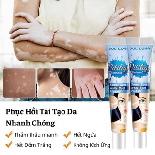 Kem Hết Bạch Biến, Đanh Bay Lang Ben, Phục Hồi Cho Da Đều Màu Loại Bỏ Các Đốm Trắng