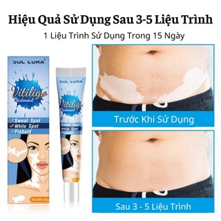 Kem Hết Bạch Biến, Đanh Bay Lang Ben, Phục Hồi Cho Da Đều Màu Loại Bỏ Các Đốm Trắng