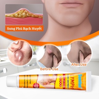 Kem Bôi Hết Nổi Hạch Sưng Phù Bạch Huyết, Ngăn Ngừa Đau Nhức Và Lưu Thông Máu