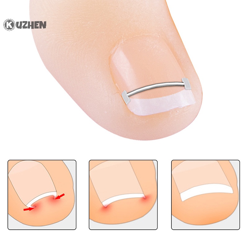 Dụng Cụ Chỉnh Hình Móng Chân Mọc Ngược Chuyên Nghiệp