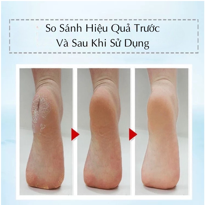 Kem Dưỡng Da Chân Vitamin E Giúp Dưỡng Ẩm, Chống Nứt Nẻ, Khô Ráp, Chai Sần, Hồi Phục Gót Chân Nứt Nẻ, Dưỡng Da Mềm Mịn