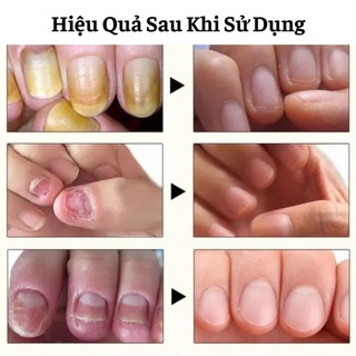 Serum Đánh Bay Nấm Móng Tay Chân Tái Tạo Móng Chắc Khỏe Sáng Bóng