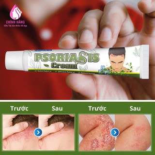 Kem Ngăn Ngừa Vẩy Nến, Á Sừng, Nấm Ngứa Da Đầu Và Toàn Thân Chữa Lành Và Phục Hồi Da 20g