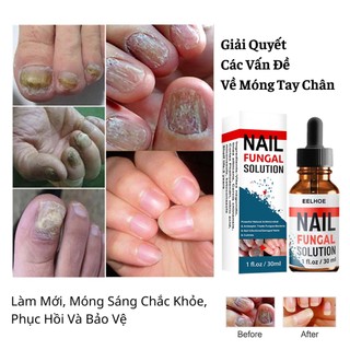 Serum Đánh Bay Nấm Móng Tay Chân Tái Tạo Móng Chắc Khỏe Sáng Bóng