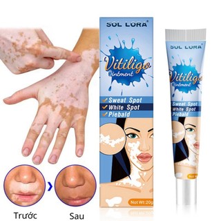 Kem Hết Bạch Biến, Đanh Bay Lang Ben, Phục Hồi Cho Da Đều Màu Loại Bỏ Các Đốm Trắng