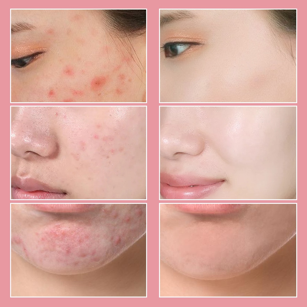 Miếng Dán Hydrocolloid Thoáng Khí Che Khuyết Điểm Mụn Vô Hình Nhẹ Nhàng Nhiều Màu Sắc Chăm Sóc Da Mặt - Dụng Cụ Chăm Sóc Da Mặt