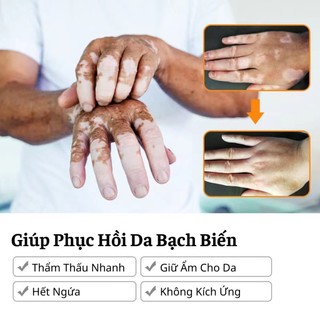 Kem Hết Bạch Biến, Đanh Bay Lang Ben, Phục Hồi Cho Da Đều Màu Loại Bỏ Các Đốm Trắng