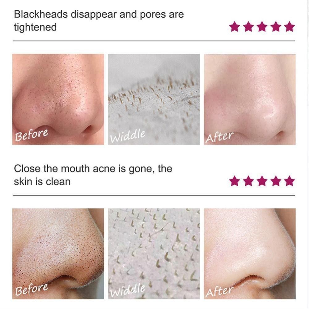 Tẩy mụn đầu đen mũi SAIA, Chăm sóc da Thu nhỏ lỗ chân lông MANGO BLACKHEAD, Làm sạch sâu mặt Mũi lột