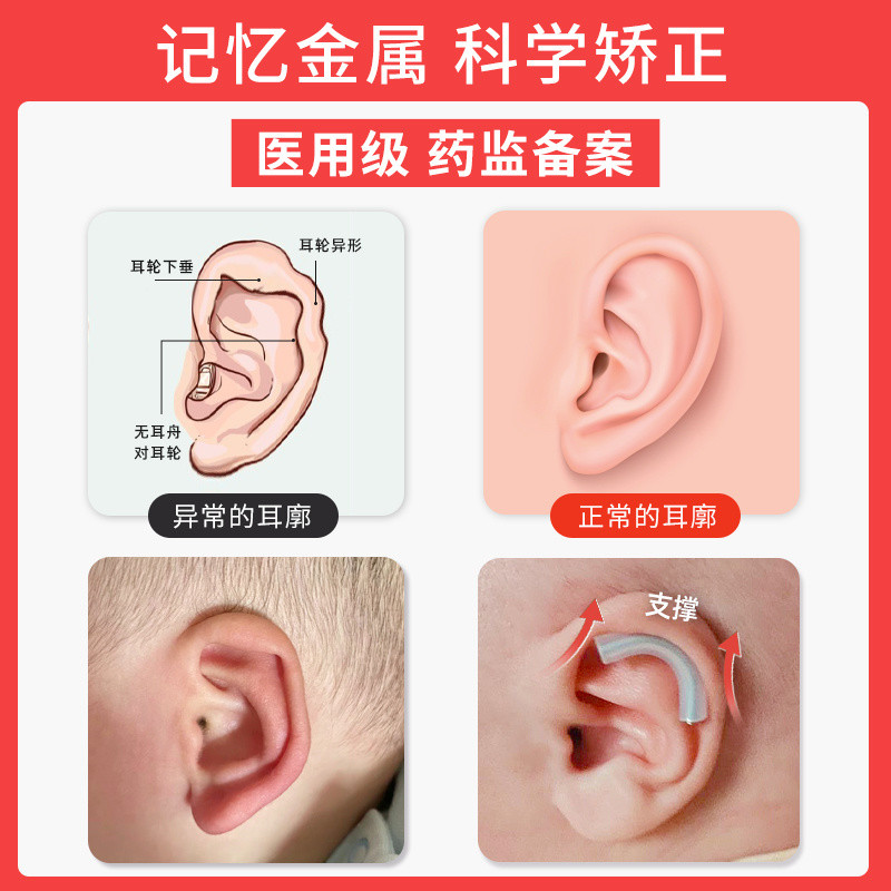 Auricle Correction 3.19 Biến Dạng Tai Sơ Sinh Chỉnh Sửa Tai Bé Lop Hình Tai Định Hình Corrector