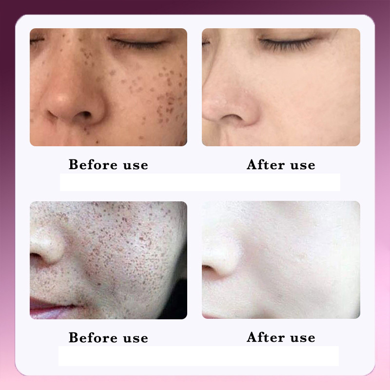 Niacinamide tinh chất làm trắng làm trắng da mặt tinh chất tàn nhang 30ml làm sáng màu da cải thiện sắc tố và đốm đen nu