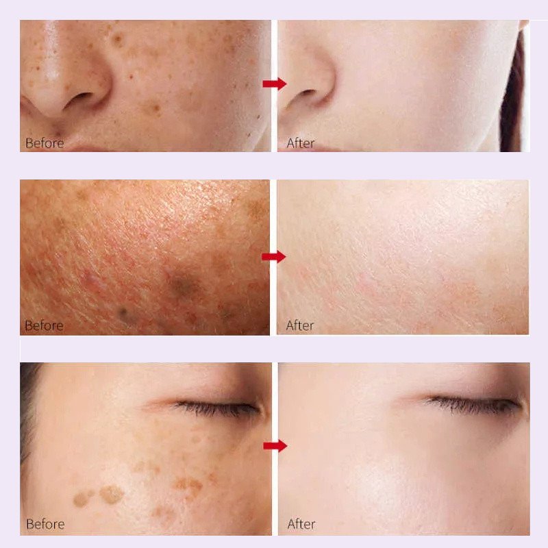 Niacinamide tinh chất làm trắng làm trắng da mặt tinh chất tàn nhang 30ml làm sáng màu da cải thiện sắc tố và đốm đen nu