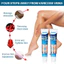 Sumifun Kem Suy Giãn Tĩnh Mạch Giúp Giảm Đau Mỏi, Mất Thẩm Mỹ Do Suy Giãn Tĩnh Mạch Gây Ra