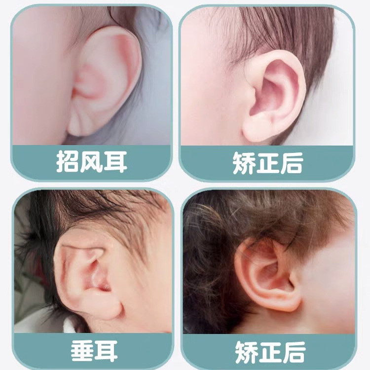 Auricle Correction 3.19 Biến Dạng Tai Sơ Sinh Chỉnh Sửa Tai Bé Lop Hình Tai Định Hình Corrector