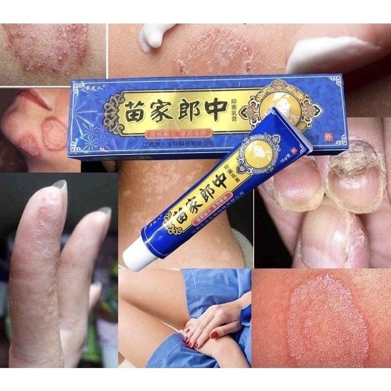 Kem bôi vảy nến, nấm ngứa, á sừng - Bà Lão Xanh