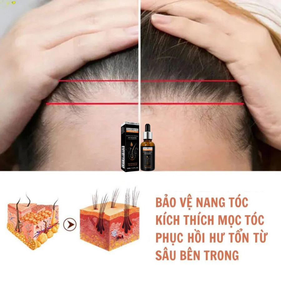Serum Tinh Chất Mọc Tóc Giảm Gàu, Thảo Dược Kích Thích Mọc Tóc Giảm Nấm Ngứa , Bảo Tóc Chắc Khoẻ