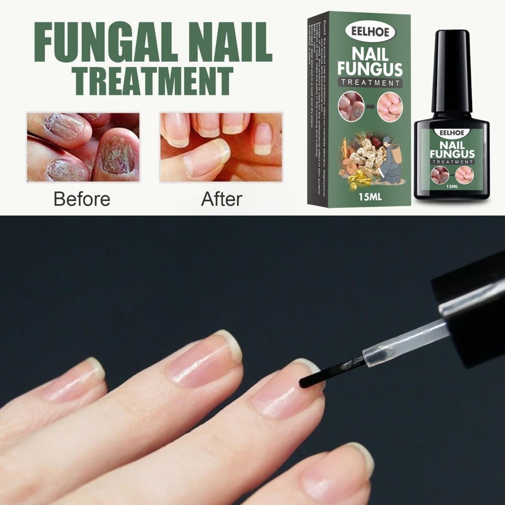 Serum Nấm Móng Tay Chân ELLHOE Hết Sạch Nấm, Bọng Móng, Hư Khoé, Nước Ăn Tay Chân, Dưỡng Cứng Móng