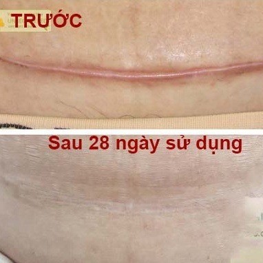 [ COMBO 5] Miếng ép sẹo lồi Eclar Plaster Hisamitsu Nhật Bản, hỗ trợ làm xẹp, làm mềm và mờ sẹo