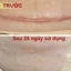 Miếng ép sẹo lồi Eclar Plaster Hisamitsu Nhật Bản, hỗ trợ làm xẹp, làm mềm và mờ sẹo