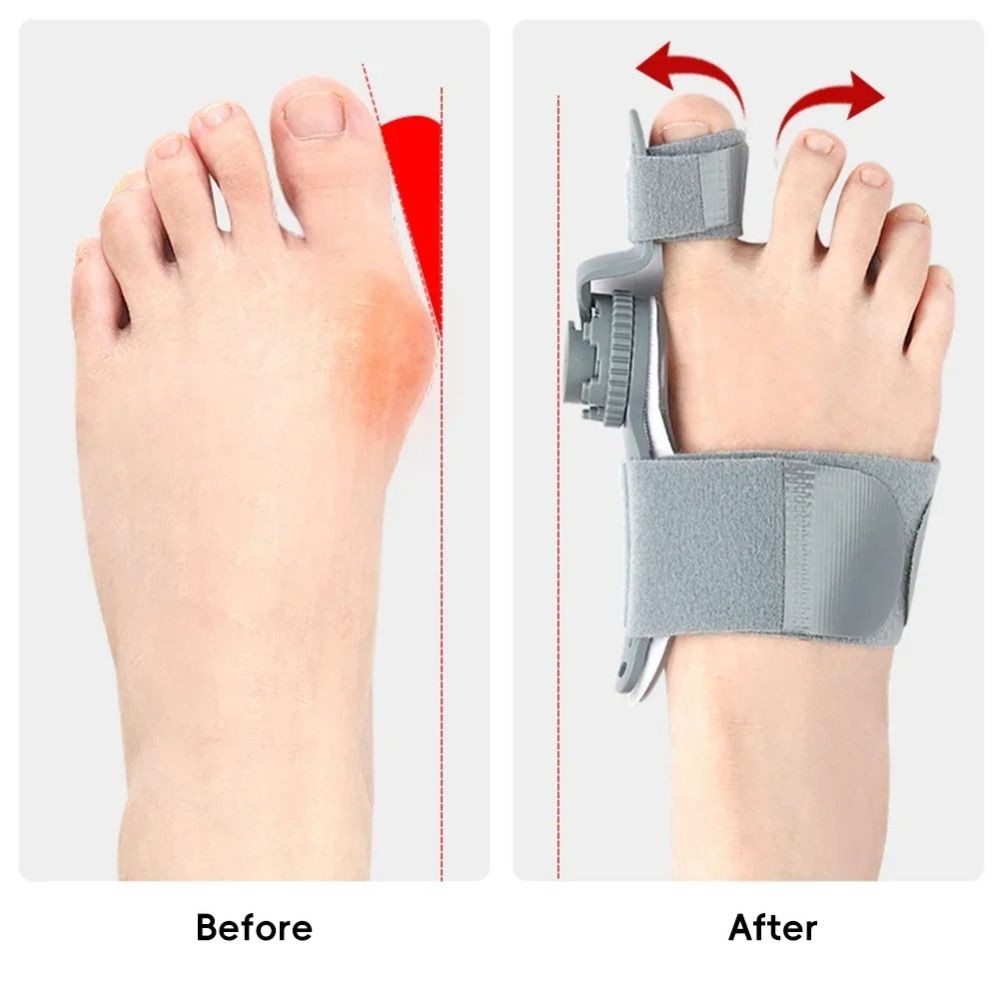 LOMBARDY Bunion Corrector, Máy duỗi ngón chân lớn Valgus có thể điều chỉnh, Cố định ngón chân Di chuyển gãy xương Hỗ trợ khớp Xoay được Nẹp chỉnh sửa chân ngoài trời