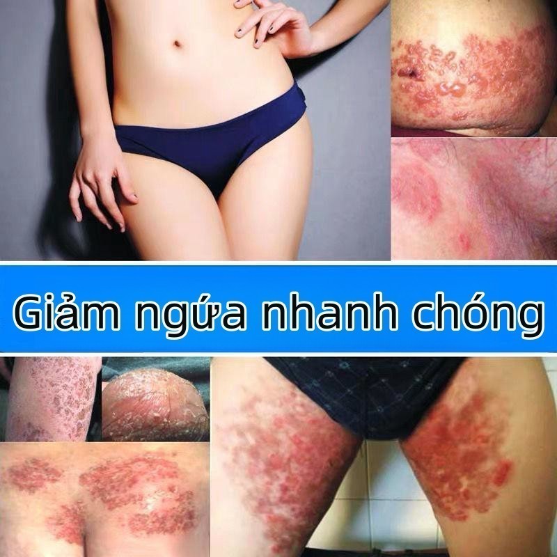 Kem Bôi Đa Năng NHẬT BẢN   Giảm Ngứa Tức Thì - Nấm Da, Hắc Lào, Tổ Đỉa, Vảy Nến | Thảo Dược Dịu Nhẹ, Không Kích Ứng