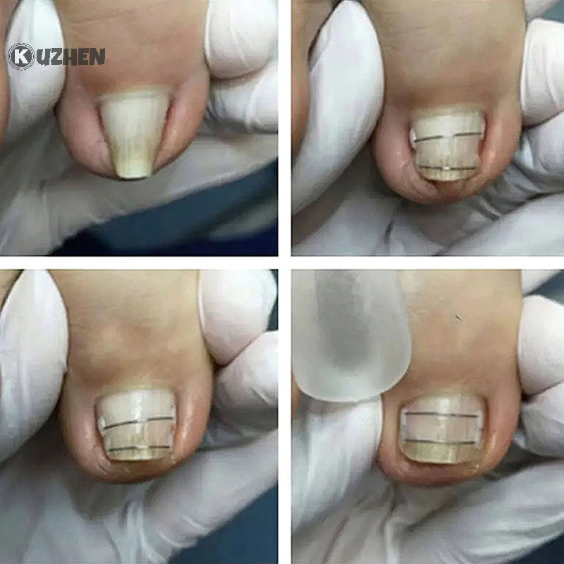 Kuzhen Công cụ chỉnh sửa móng chân mọc ngược Phục hồi móng chân Nhúng móng chân mọc ngược Điều trị móng chân Kẹp thẳng Nẹp HOT