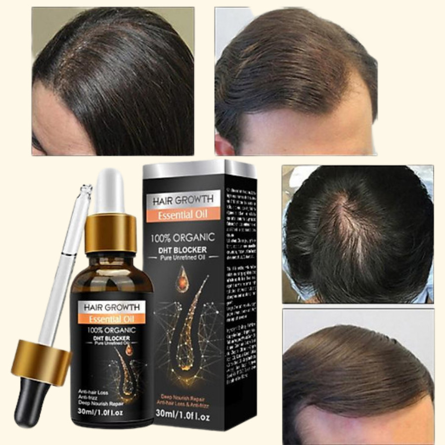 Serum Tinh Chất Mọc Tóc Giảm Gàu, Thảo Dược Kích Thích Mọc Tóc Giảm Nấm Ngứa , Bảo Tóc Chắc Khoẻ