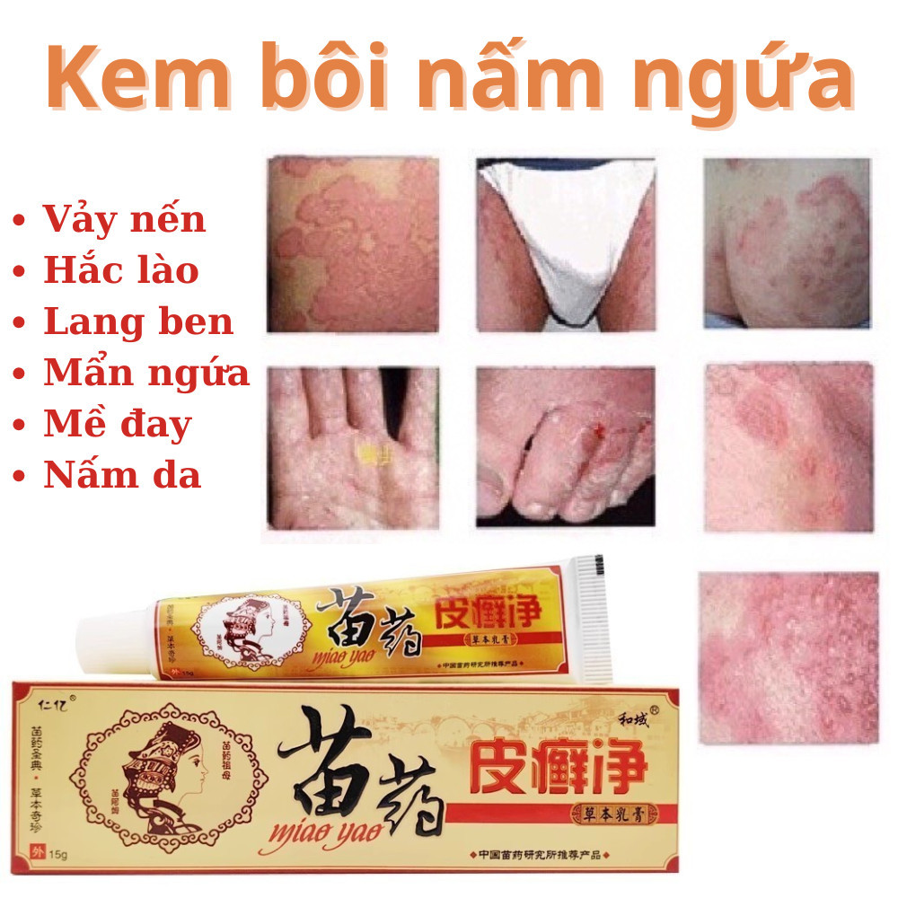 [Miao Vàng] Kem Bôi Da Liễu chính hãng - Dùng cho Hắc Lào, Vảy Nến, Mề Đay, Ngứa Nấm và Lang Ben Hiệu quả
