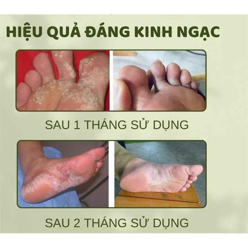 [ Tiến Sĩ Xanh] Kem Bôi Viêm Da Cơ Địa, Hắc Lào, Nấm Ngứa Đầu Chàm ,Tổ Đỉa Ghẻ Nước, Lang Ben, Á Sừng, Tuýp 15Gr