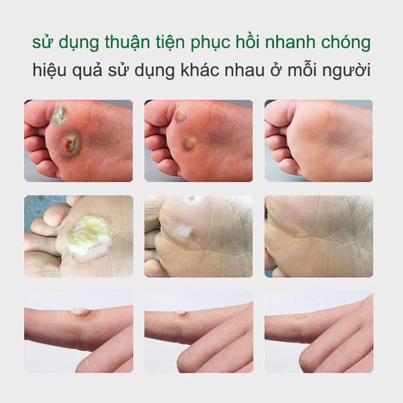[ Tiến Sĩ Xanh] Kem Bôi Viêm Da Cơ Địa, Hắc Lào, Nấm Ngứa Đầu Chàm ,Tổ Đỉa Ghẻ Nước, Lang Ben, Á Sừng, Tuýp 15Gr