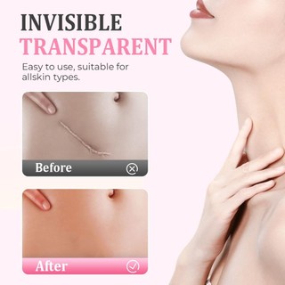 Tấm sẹo silicon cuộn 2026 Dải băng silicon mềm cho nếp nhăn mặt Mụn Keloid Bump Instant Plumping Thích hợp cho mọi làn da silicone đa năng phù hợp dùng cho gia đình căn hộ văn phòng và không gian nhỏ