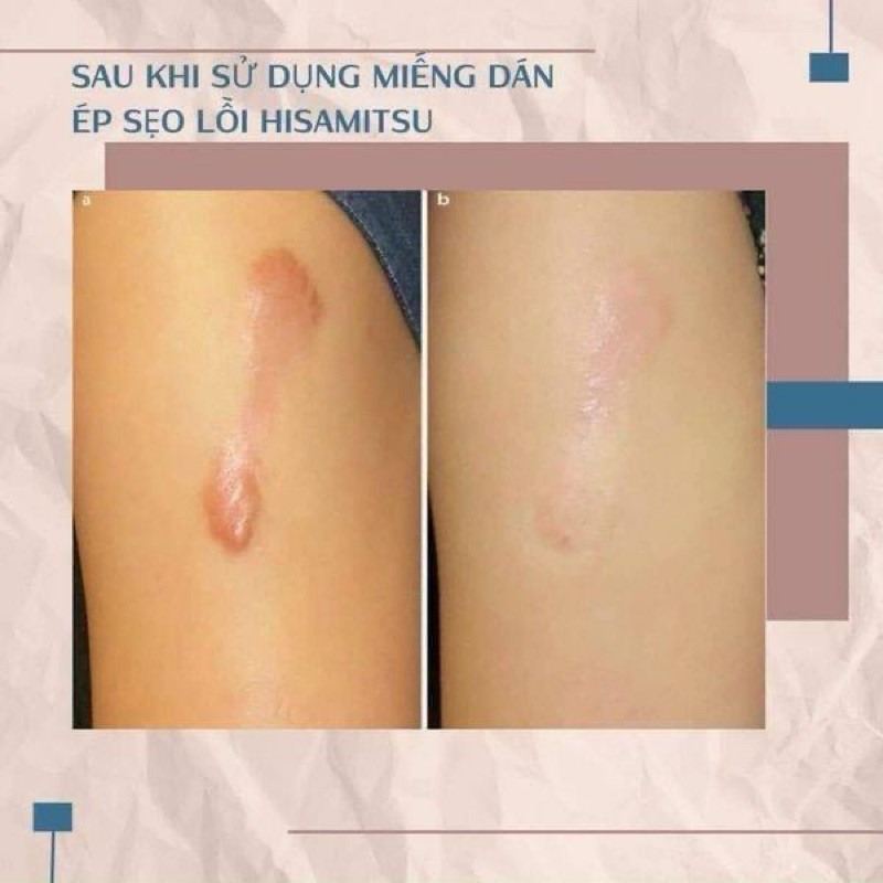 [ COMBO 5] Miếng ép sẹo lồi Eclar Plaster Hisamitsu Nhật Bản, hỗ trợ làm xẹp, làm mềm và mờ sẹo