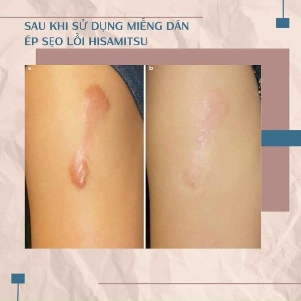 lLẻ 1 Miếng ép Sẹo Lồi  ECLAR PLASTER - Hisamisu Nội địa Nhật Bản, giảm sẹo, ép sẹo, làm đều màu