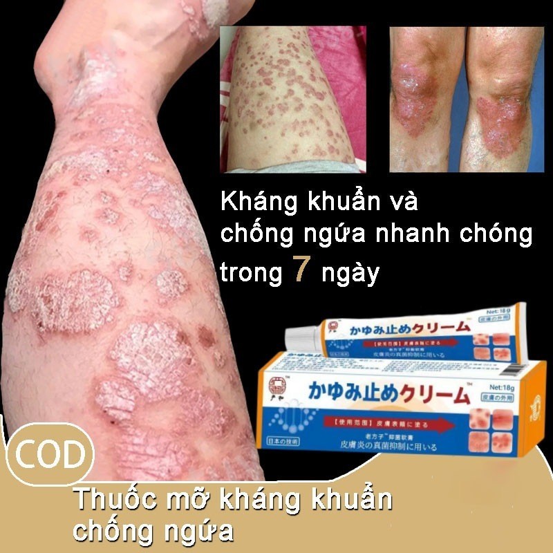 ❤[CHÍNH HÃNG] Kem Nhật Bản Bôi Nấm Kem Bôi Hắc Lào Thảo Dược, Phát Ban Tổ Đĩa