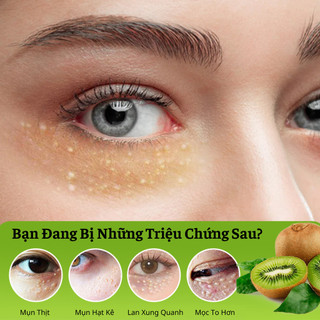 Kem Bôi Hết Sạch Mụn Thịt Quanh Mắt Và Toàn Bộ Cơ Thể  Bổ Sung Vitamin E Làm Trắng Sáng Da