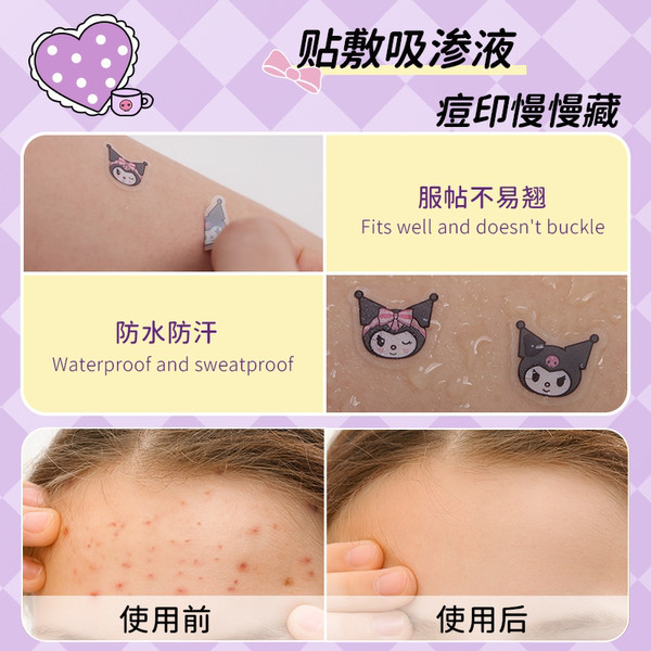 🔥 làm dịu 🔥 miếng dán trị mụn Hydrogel miếng dán hút mụn cute Miếng dán chăm sóc da mụn trứng cá có hàng sẵn miếng dán mụn thoáng khí và hấp thụ mủ ♖AUSLKA Sanrio Chính Hãng Kulomi Pock Patch Chống Thấm Nước Không Kích Ứng Hydrocolloid Nhẹ Thoáng Khí Má
