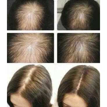 Hộp tinh chất mọc tóc thảo dược chống hói, rụng Sato AROVICS Solution 5% Nhật Bản 12x30ml [ TN ]