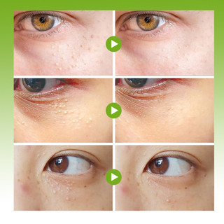 Kem Bôi Hết Sạch Mụn Thịt Quanh Mắt Và Toàn Bộ Cơ Thể  Bổ Sung Vitamin E Làm Trắng Sáng Da