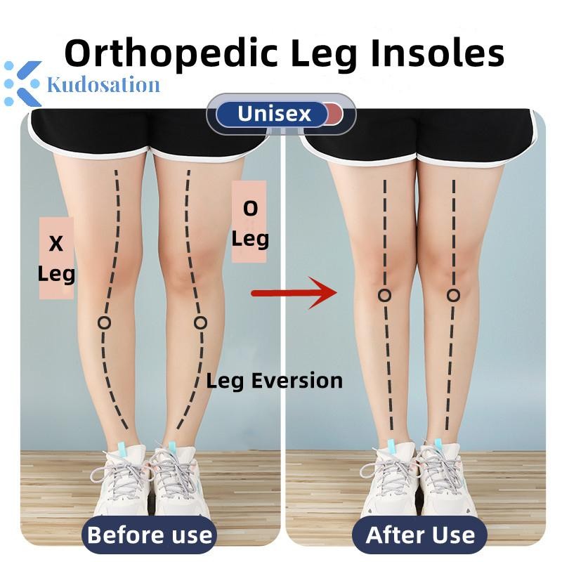 Kudosation Silicone Chỉnh Hình Đế Cho Chân O / X Loại Chân Valgus Varus Chỉnh Plantar Fasciitis Gel Đế Lót Nam Châm Massage Chăm Sóc Bàn Chân