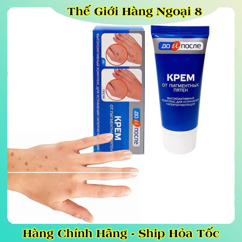 Kem đồi mồi Kpem Nga 50ml xóa mờ đồi mồi tay, tàn nhang dưỡng da tay trắng sáng mịn màng của Nga