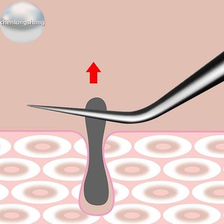 Chenlongshang 8CM Cell Pimples Blackhead Clip Nhíp Thẩm Mỹ Viện Cạo Đặc Biệt Đóng Hiện Vật Hỗ trợ giảm mụn Dụng Cụ EN