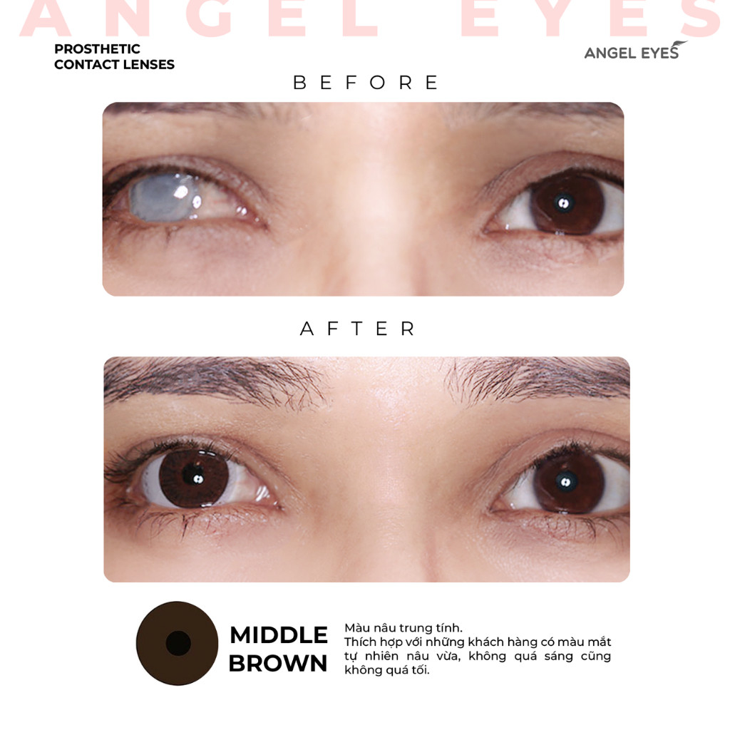 Lens Thẩm Mỹ Che Khuyết Điểm An.gel Ey.es, Kính Áp Tròng Cho Mắt Bị Đục Thủy Tinh Thể, Kéo Mây, Cườm